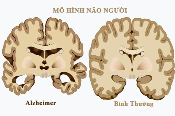 Chứng mất trí nhớ 2